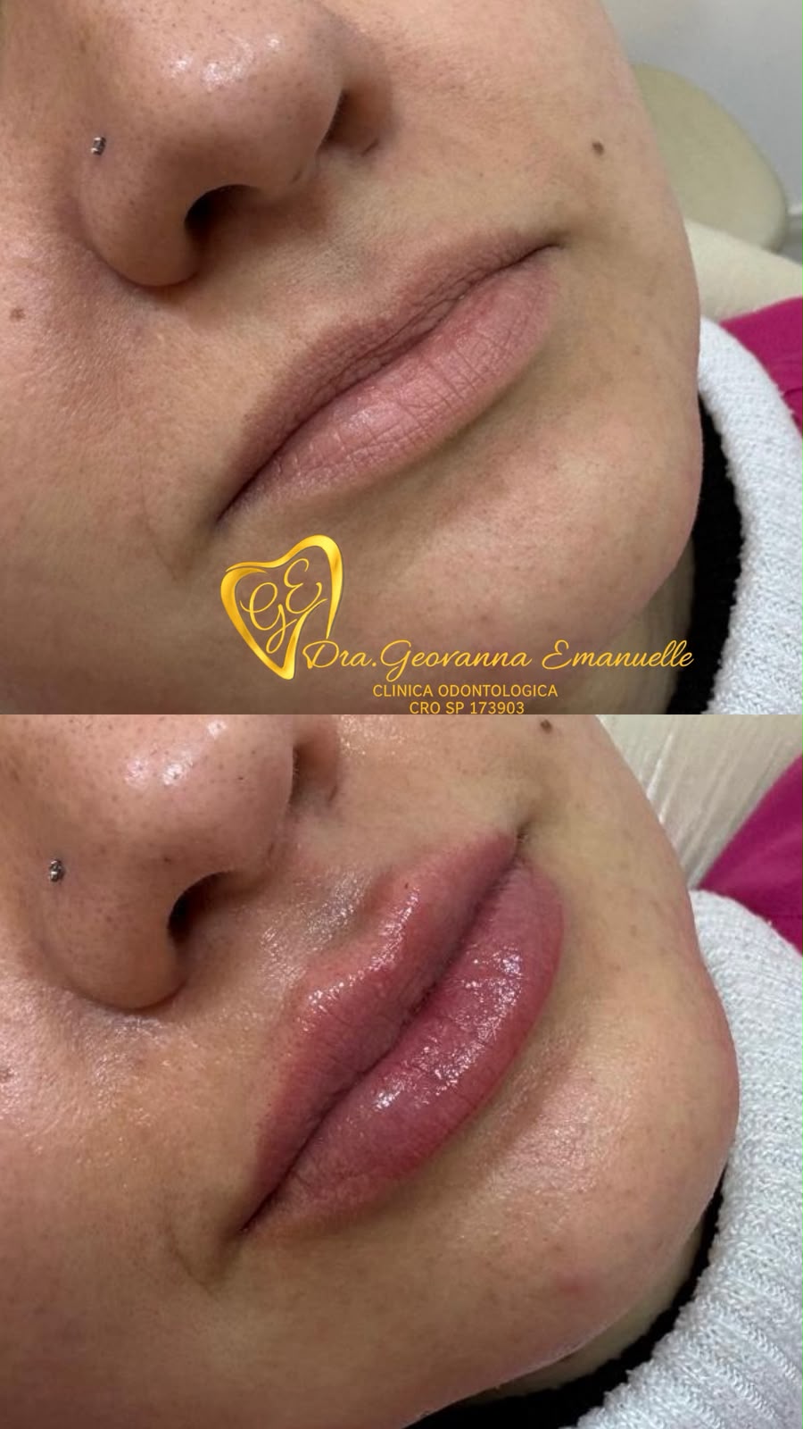 Preenchimento labial publicado pela clínica